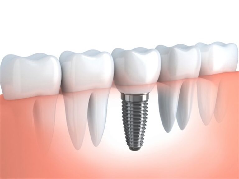 IMPLANTES: Adhesión voluntaria para profesionales